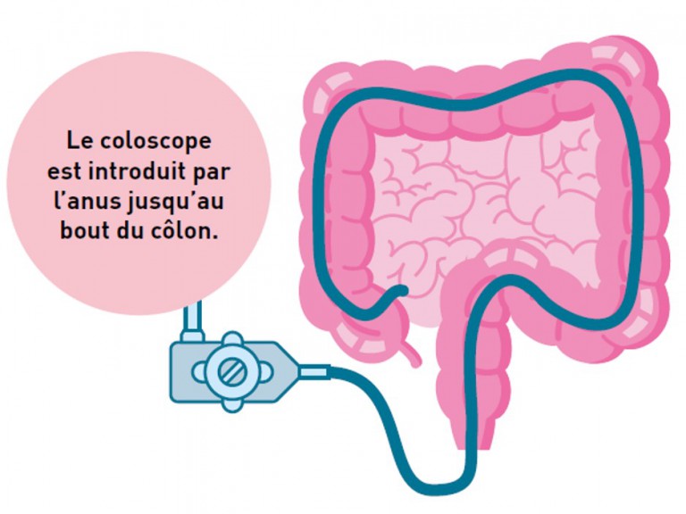 Je dois passer une coloscopie Vocation Santé