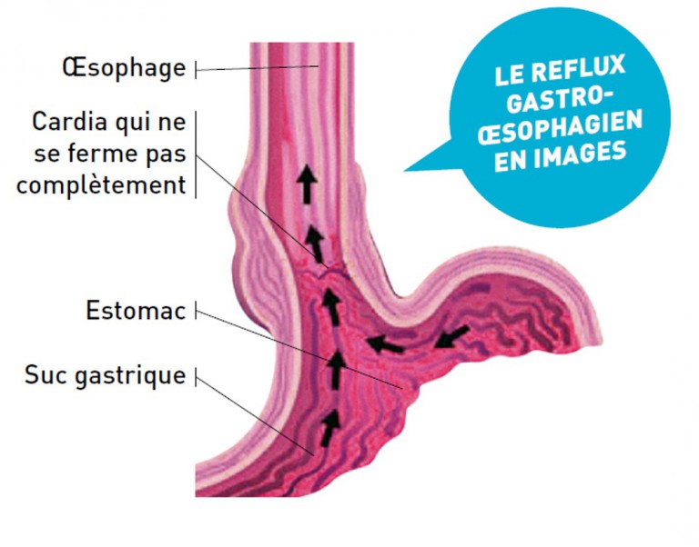 Attention à votre estomac Vocation Santé