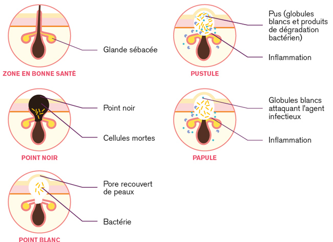 vocation-sante-mecanisme-acne