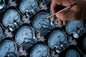 Maladie d’Alzheimer : comment reconnaître les premiers signes ...