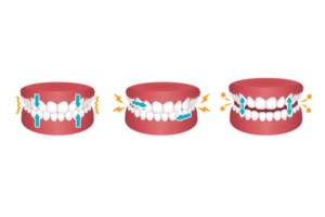 3 différents types de bruxisme
