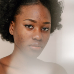 Hyperpigmentation post-inflammatoire
