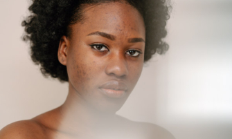 Hyperpigmentation post-inflammatoire