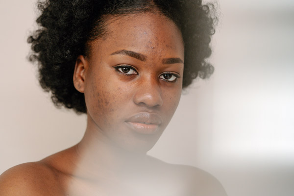 Hyperpigmentation post-inflammatoire